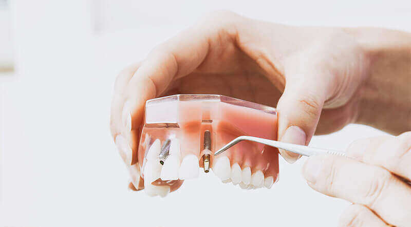 Dental Implants Wetaskiwin