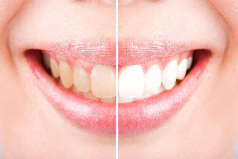 Teeth Whitening Wetaskiwin